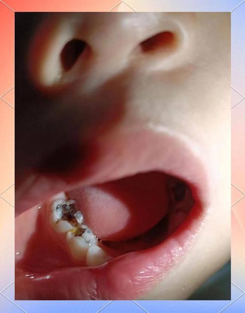 如何应对龋齿症状