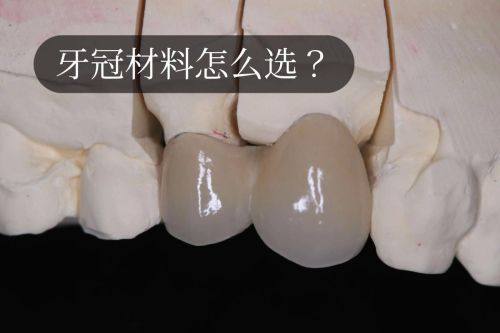 烤瓷牙在不同部位的外观呈现