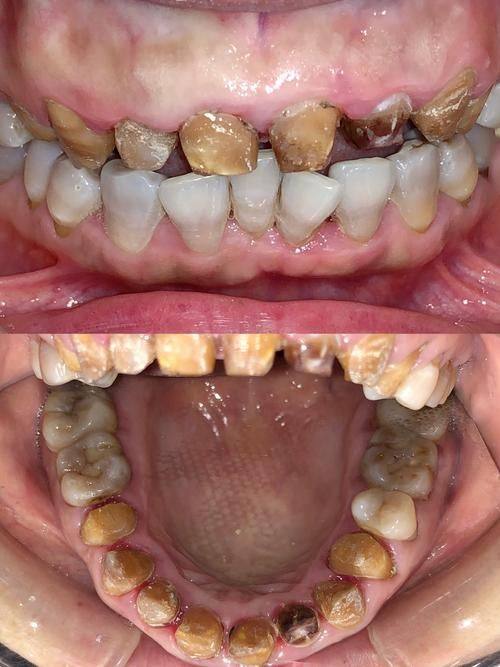 解决方案三:正畸治疗配合