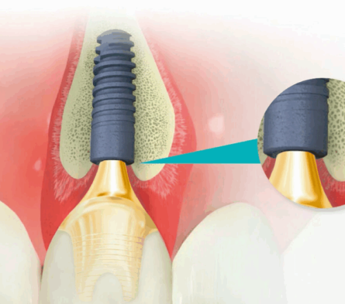 不同医院的种植牙价格差异