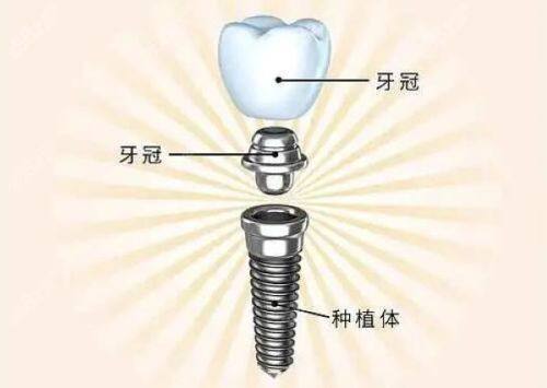 种植牙的后续维护费用