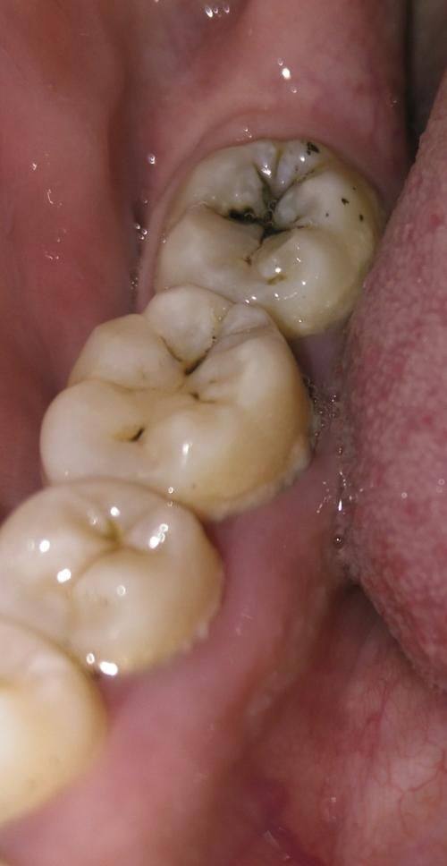 牙齿修复液的成效表现