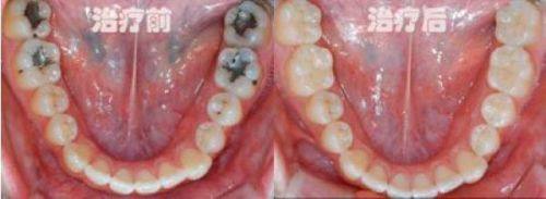 选择烤瓷牙的考量因素