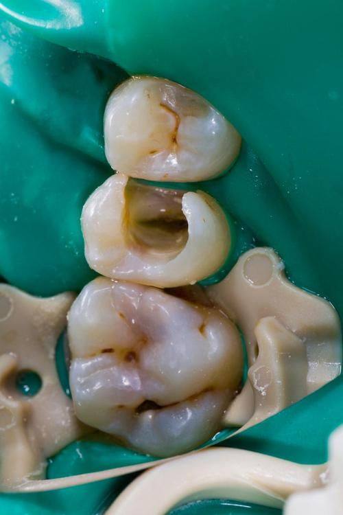 临床现实：外界干扰影响存留率