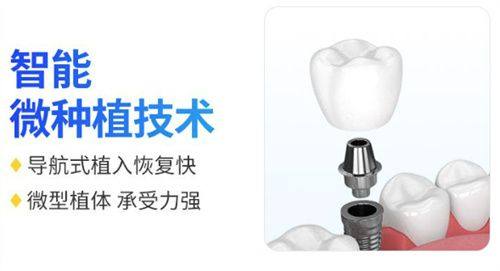 如何选择合适的种植体数量