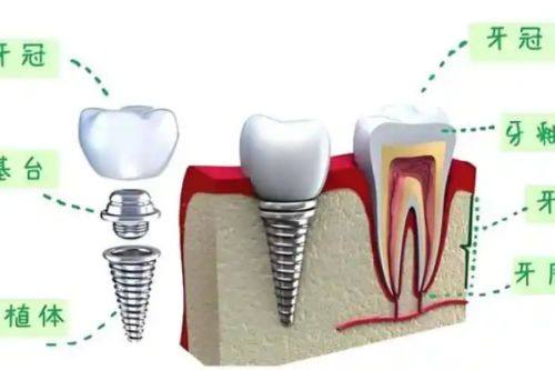 安装牙冠：修复理想笑容