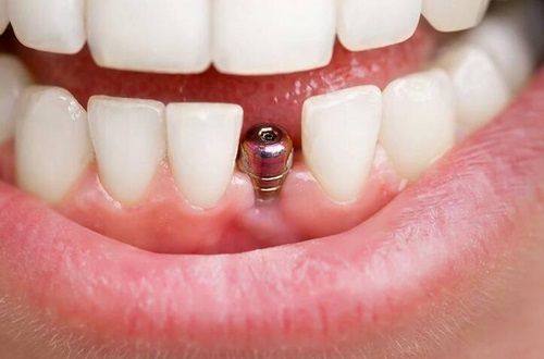 种植牙齿可以医保报销吗？看完这5个要点你就明白了！