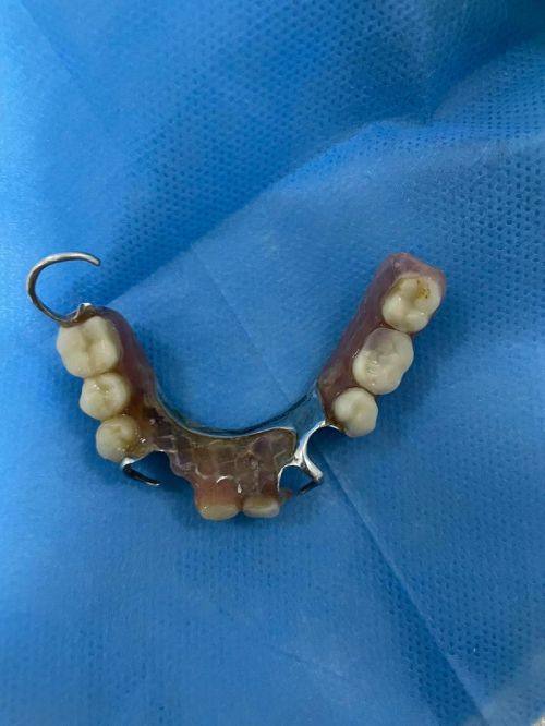 固定义齿修复：恒久修复但需磨邻牙