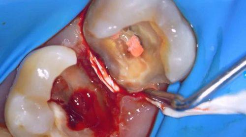 根管治疗之后的牙齿能保留一辈子吗？医生告诉你真相！