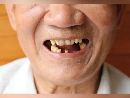 活动义齿护理的常见误区