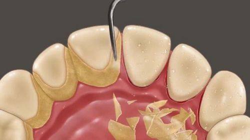 洗牙后的短暂不适：正常现象别担心