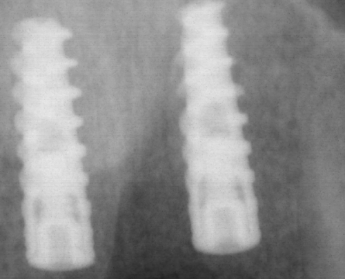 种植牙质量和安装技术的影响