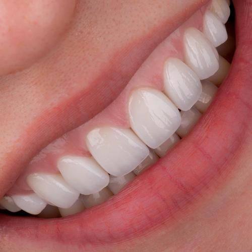 牙齿美容修复的注意事项