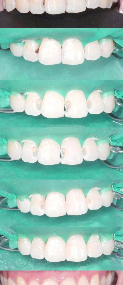 如何选择适合自己的牙齿美容修复方案