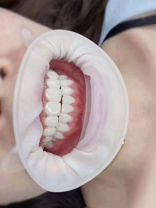 牙齿修复：弥补牙齿缺陷