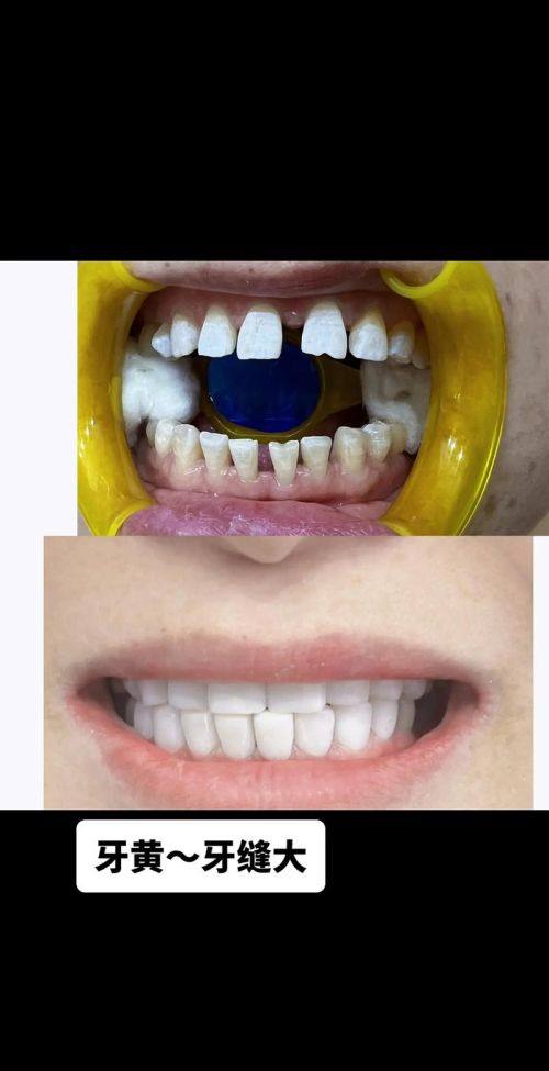 牙齿修复：弥补牙齿缺陷