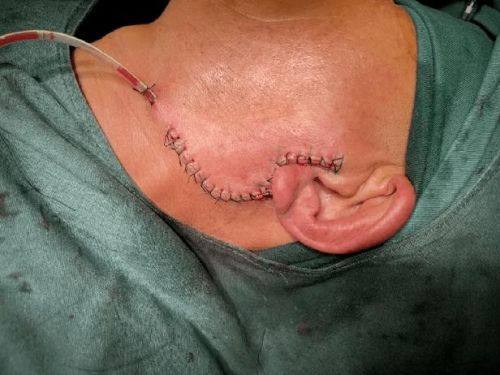 肿 瘤治疗病症:专精对抗颌面部肿物