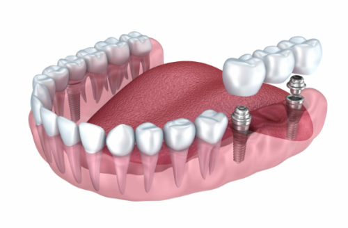 舒适度：无异物感，口腔舒适