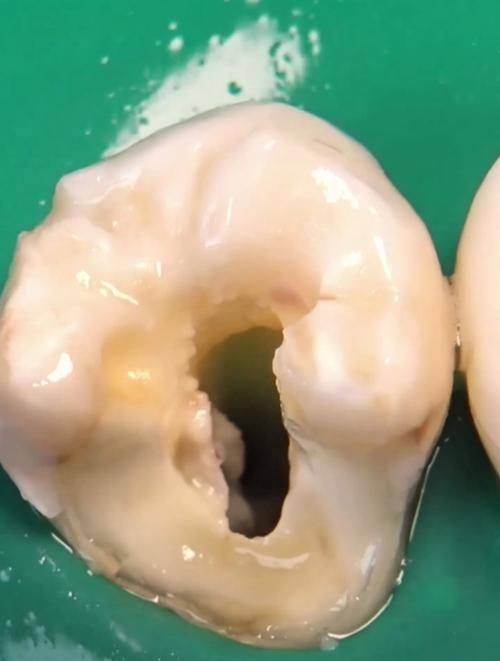 不同人群的龋齿修复价格