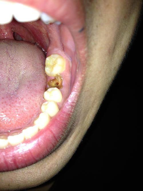 疾病特征:牙齿被“侵蚀”的过程