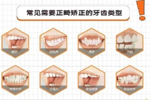 牙齿矫正的费用构成