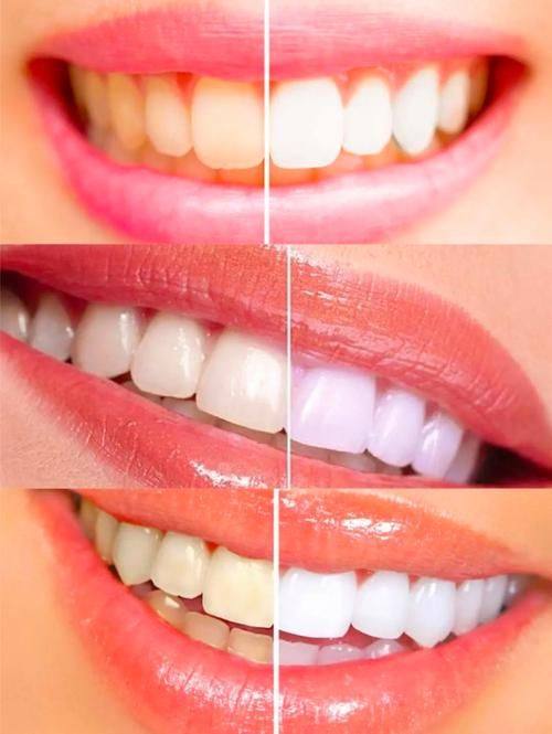 冷光美白：专精效率高的牙齿美白技术