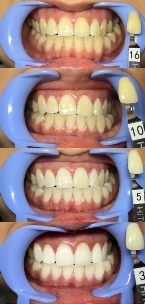 不同洗牙方式价格大揭秘