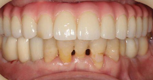 种植牙的稳定性和持久性如何