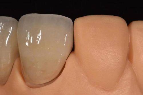 活动义齿晚上必须摘下来的原因