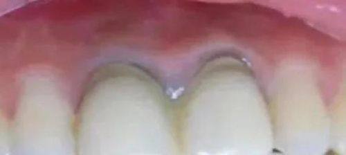 导致牙齿腐烂和异味的“元凶”