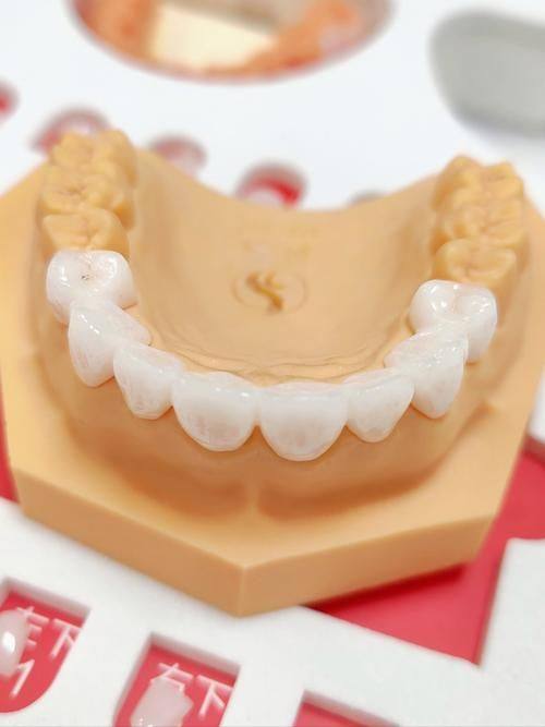 全瓷牙品牌之Procera（诺贝尔）：数字化精细之选