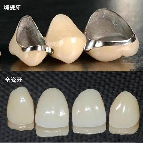 全瓷牙品牌之国产全瓷牙品牌：实惠实用之选