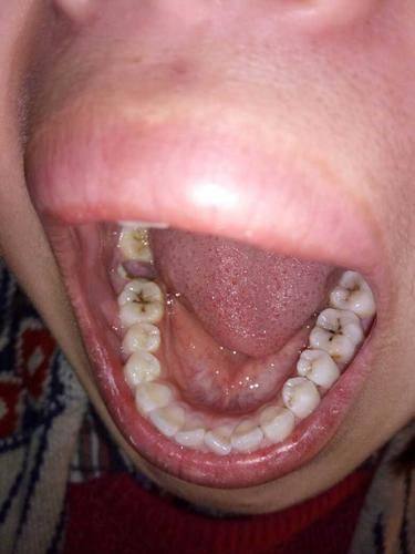 影响树脂补牙缝价格的因素