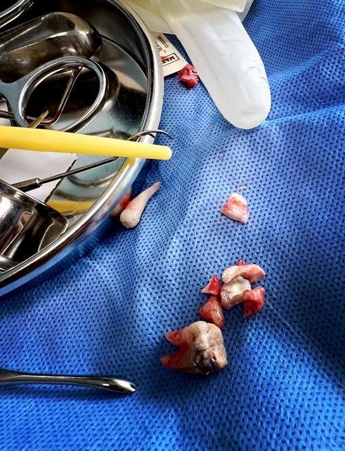 哪些情况可考虑补牙