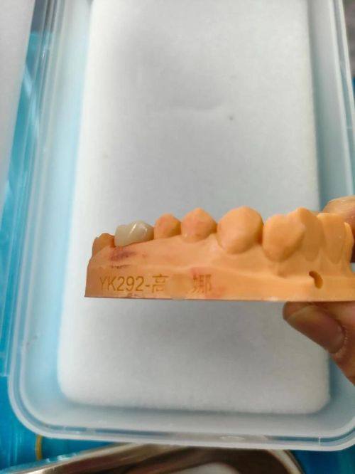 金属牙套的优势与不足