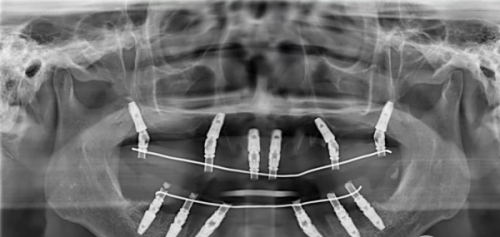 第二步：安装愈合基台