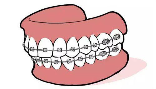 如何缩短牙齿矫正时间