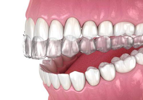 矫正方案的选择