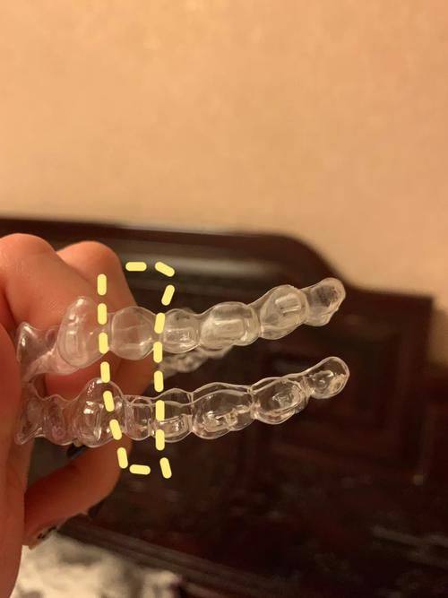 金属牙套掉落后的应急处理办法