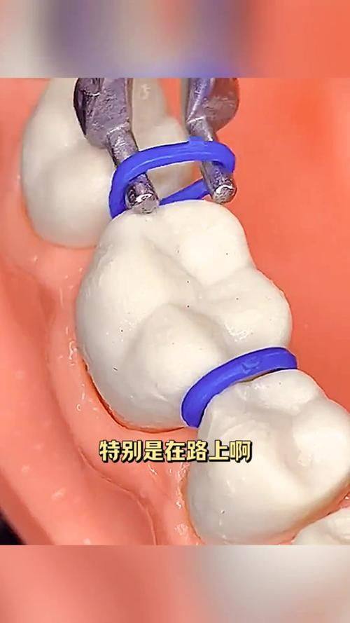 金属牙套掉了的5大解决方案总结