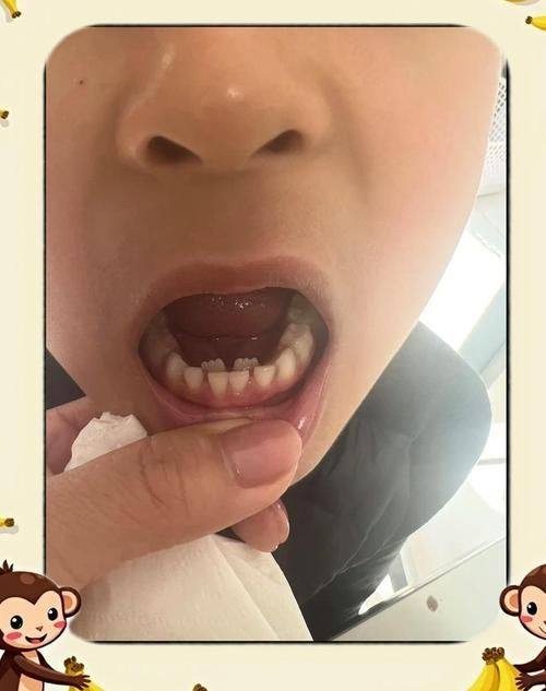 拔牙所需的时间