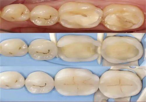 影响正规医院补牙费用的因素