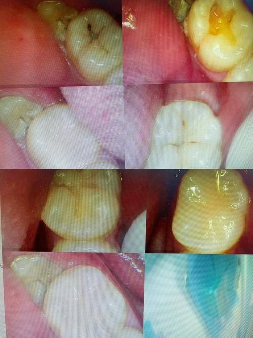 定期口腔检查的重要性