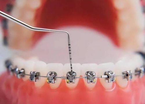 适合人群：经典矫正的拥护者