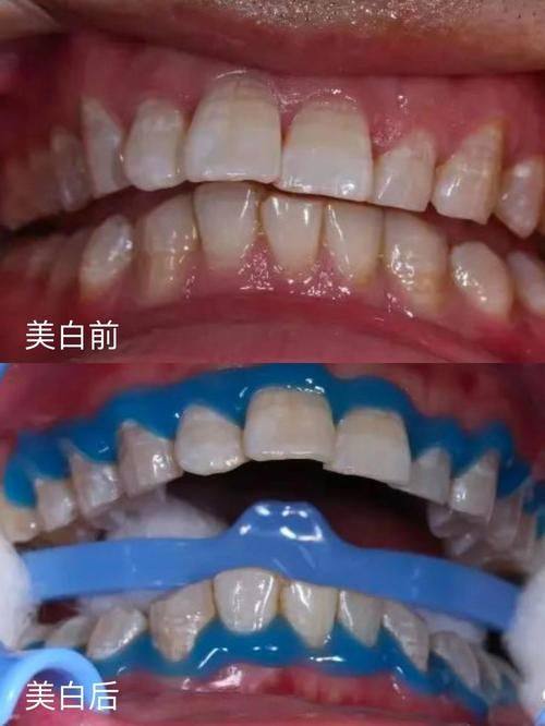 冷光美白价格与成效的真相总结