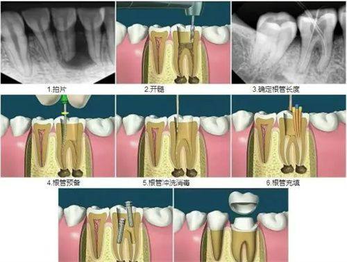 牙周健康状况对治疗牙存活期的影响