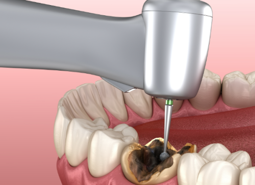 牙齿位置与根管治疗后牙齿寿命的关系
