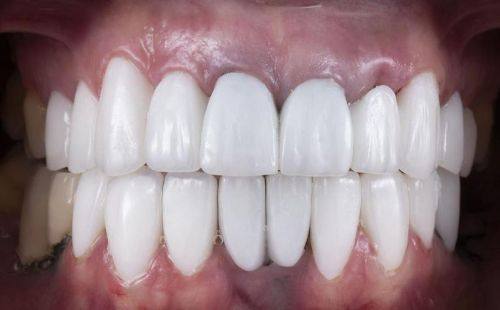 技工师傅因素对烤瓷牙寿命的影响