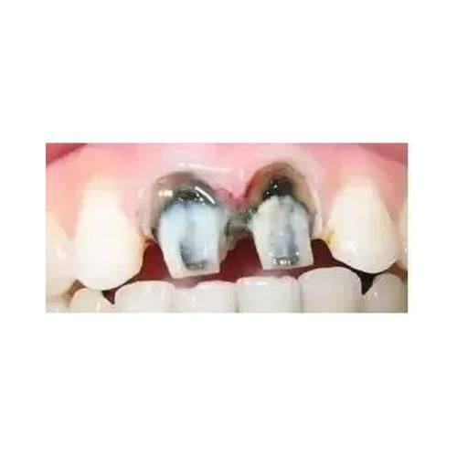 哪些情况烤瓷牙可以粘回去