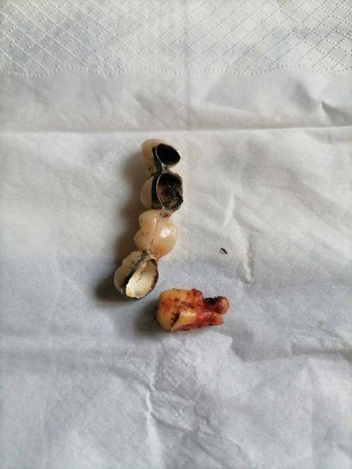 不同材质烤瓷牙对核磁共振的影响